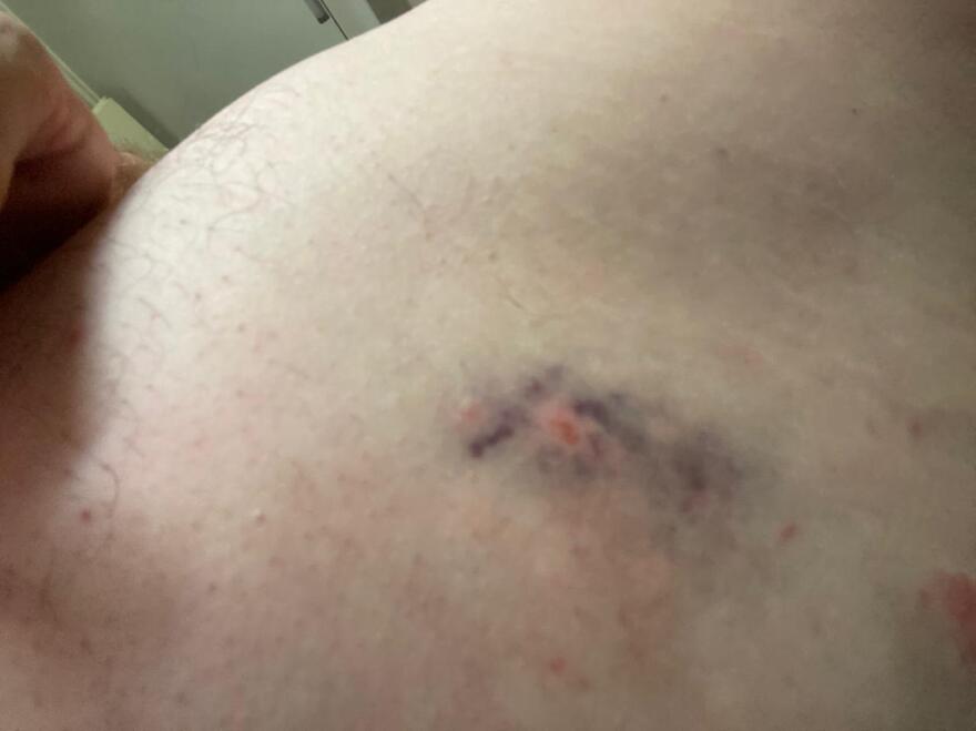 Μετς: Πατέρας και γιος έβαλαν ροτβάιλερ να επιτεθεί σε 30χρονο - Φωτογραφίες