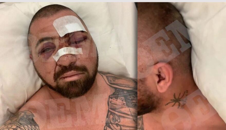 Mύκονος - Ξυλοδαρμός σωματοφύλακα: «Έχει υποστεί κατάγματα κρανίου, υπάρχει φόβος για εσωτερικά αιματώματα»