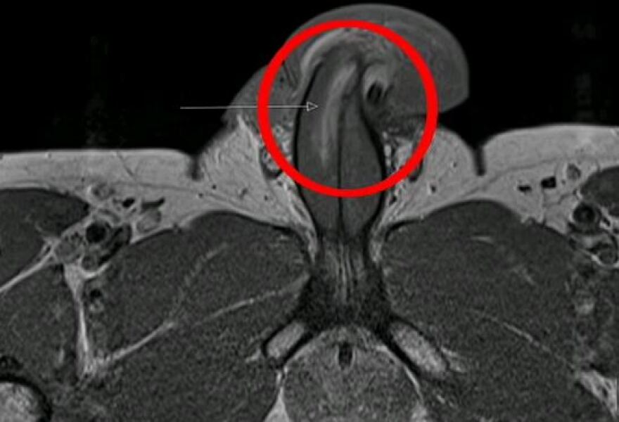 Βρετανός υπέστη κάταγμα πέους κατά τη διάρκεια του σεξ