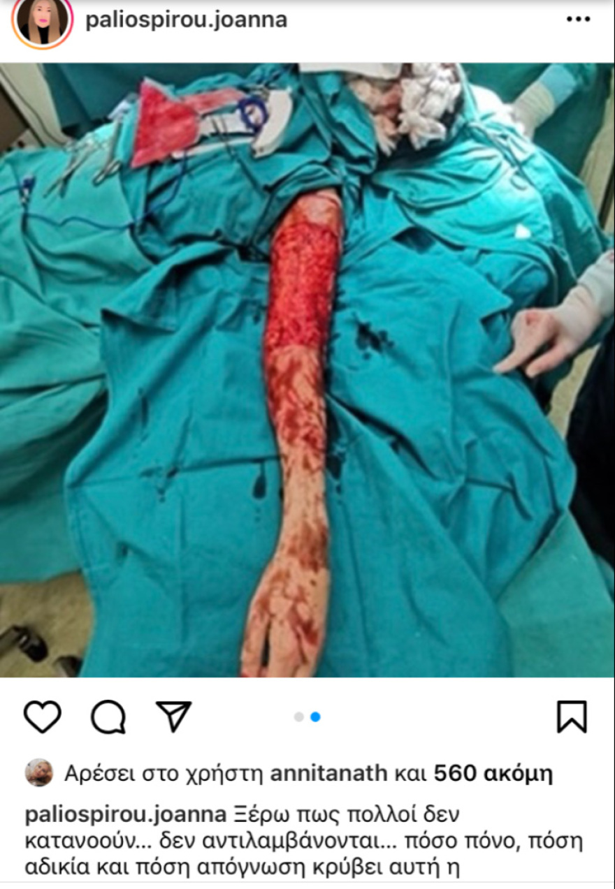  Επίθεση με βιτριόλι: Η φωτογραφία-σοκ που ανήρτησε η Ιωάννα Παλιοσπύρου