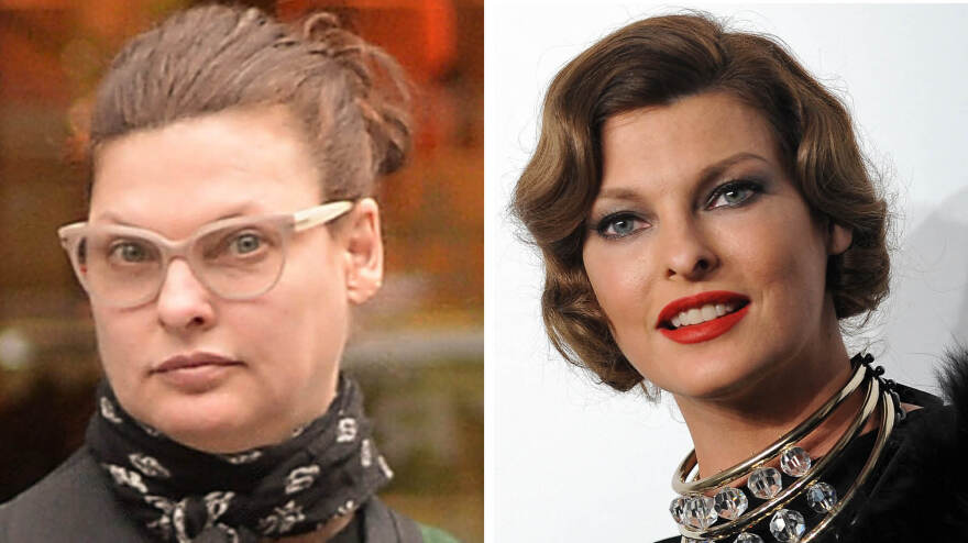 Ποιες διάσημες παραμορφώθηκαν μετά από πλαστικές επεμβάσεις