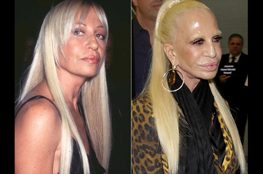 Ποιες διάσημες παραμορφώθηκαν μετά από πλαστικές επεμβάσεις