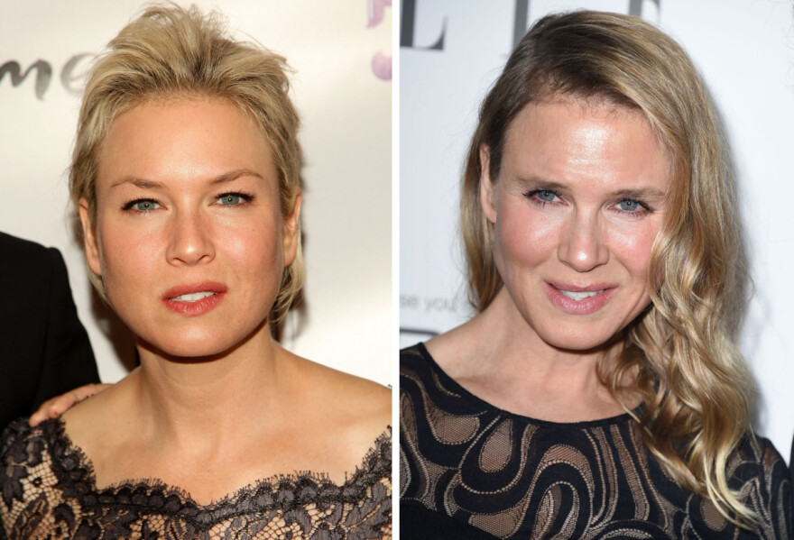 Ποιες διάσημες παραμορφώθηκαν μετά από πλαστικές επεμβάσεις