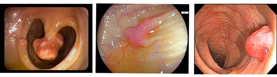 Κολονοσκόπηση, για την πρόληψη του καρκίνου του παχέος εντέρου