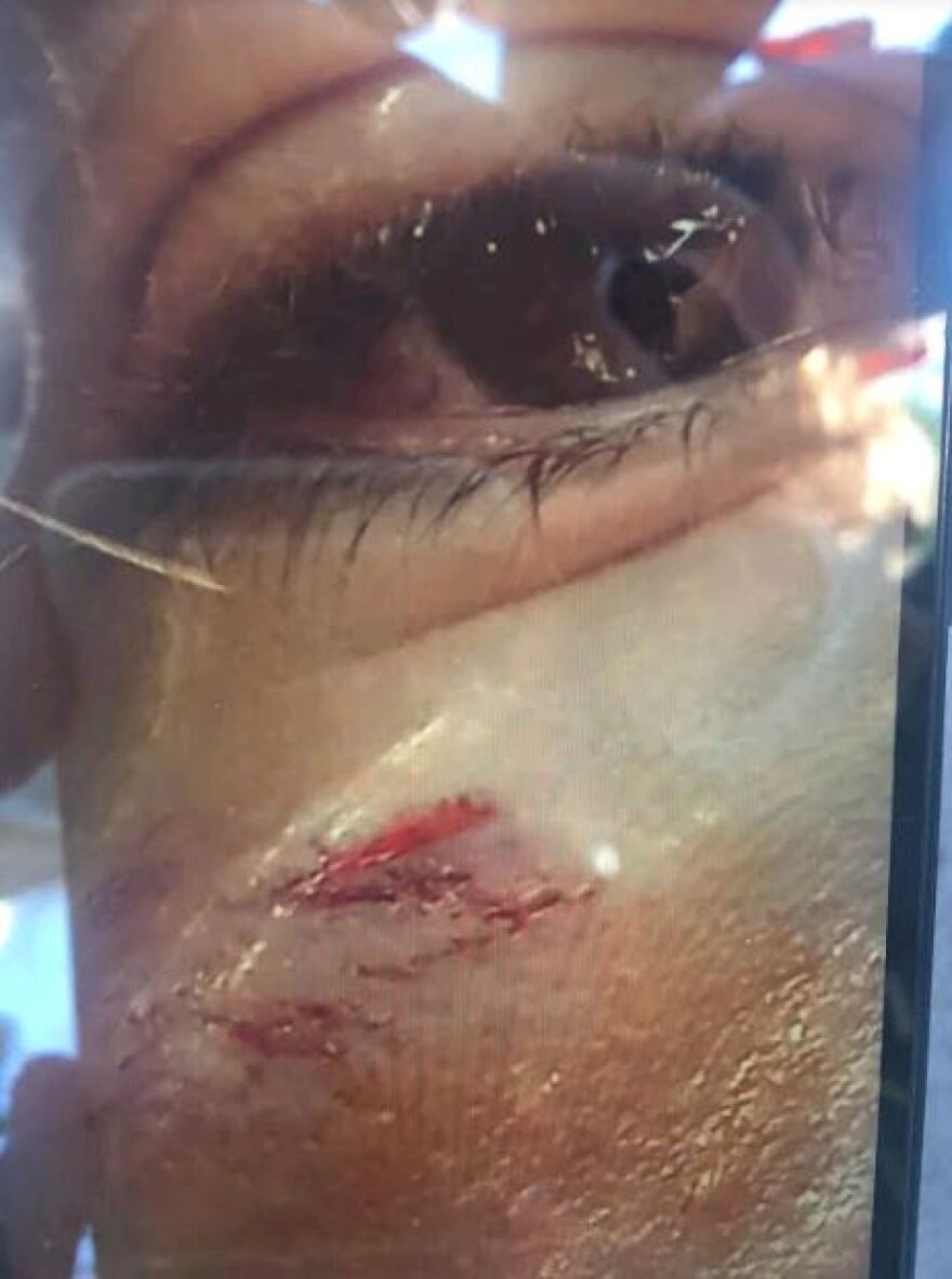 Ξυλοδαρμός στην Καλλιθέα: Ανήλικος ξυλοκόπησε 15χρονο μαθητή μέσα στο σχολείο 