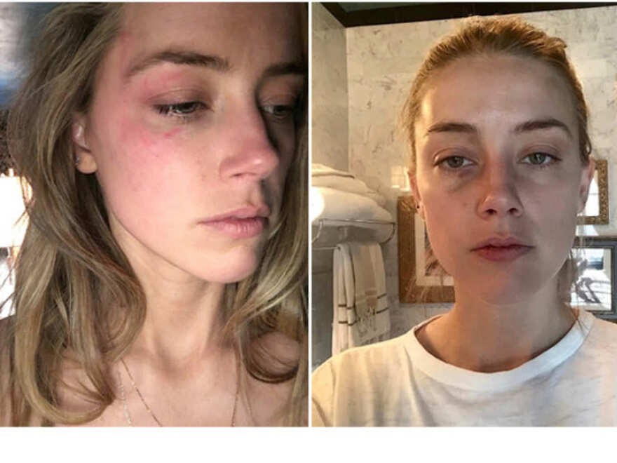 Τζόνι Ντεπ - Άμπερ Χερντ: Ντοκιμαντέρ η επική διαμάχη τους στα δικαστήρια