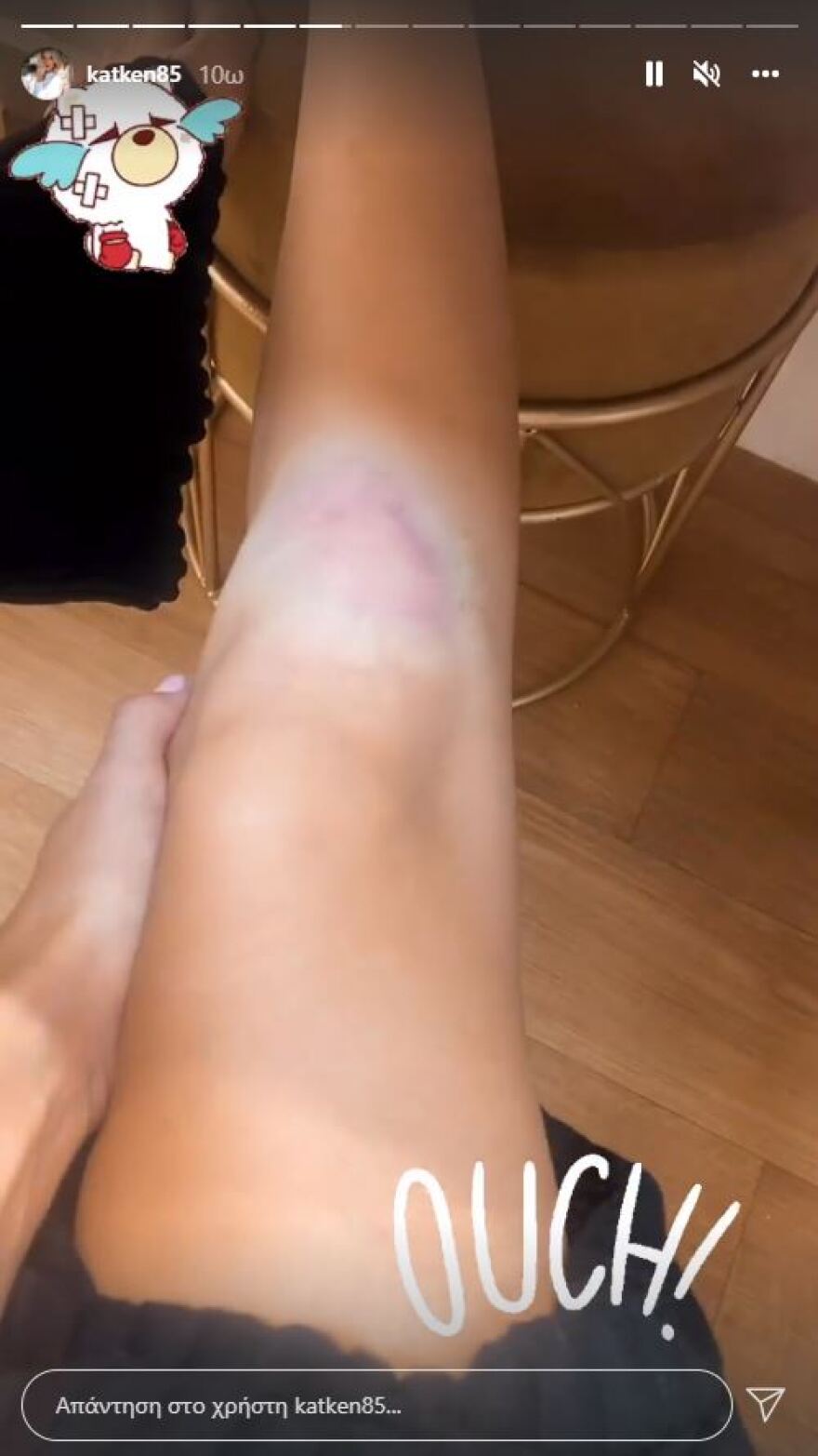 Ατύχημα είχε η Κατερίνα Καινούργιου – «Έπεσα, διαλύθηκα, το πόδι έχει γίνει τούμπανο»