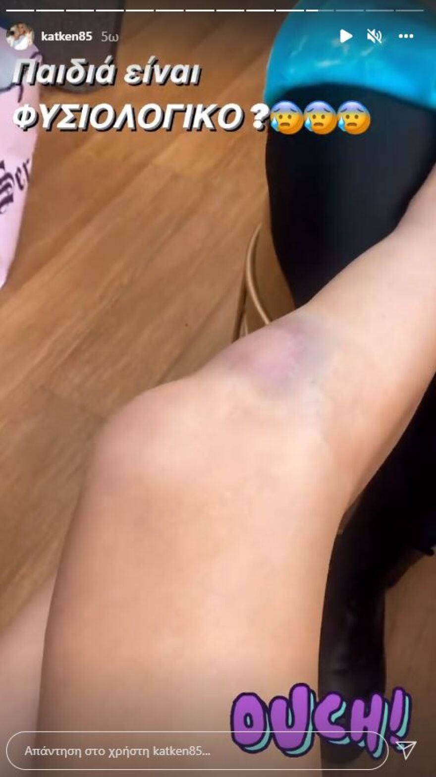 Ατύχημα είχε η Κατερίνα Καινούργιου – «Έπεσα, διαλύθηκα, το πόδι έχει γίνει τούμπανο»