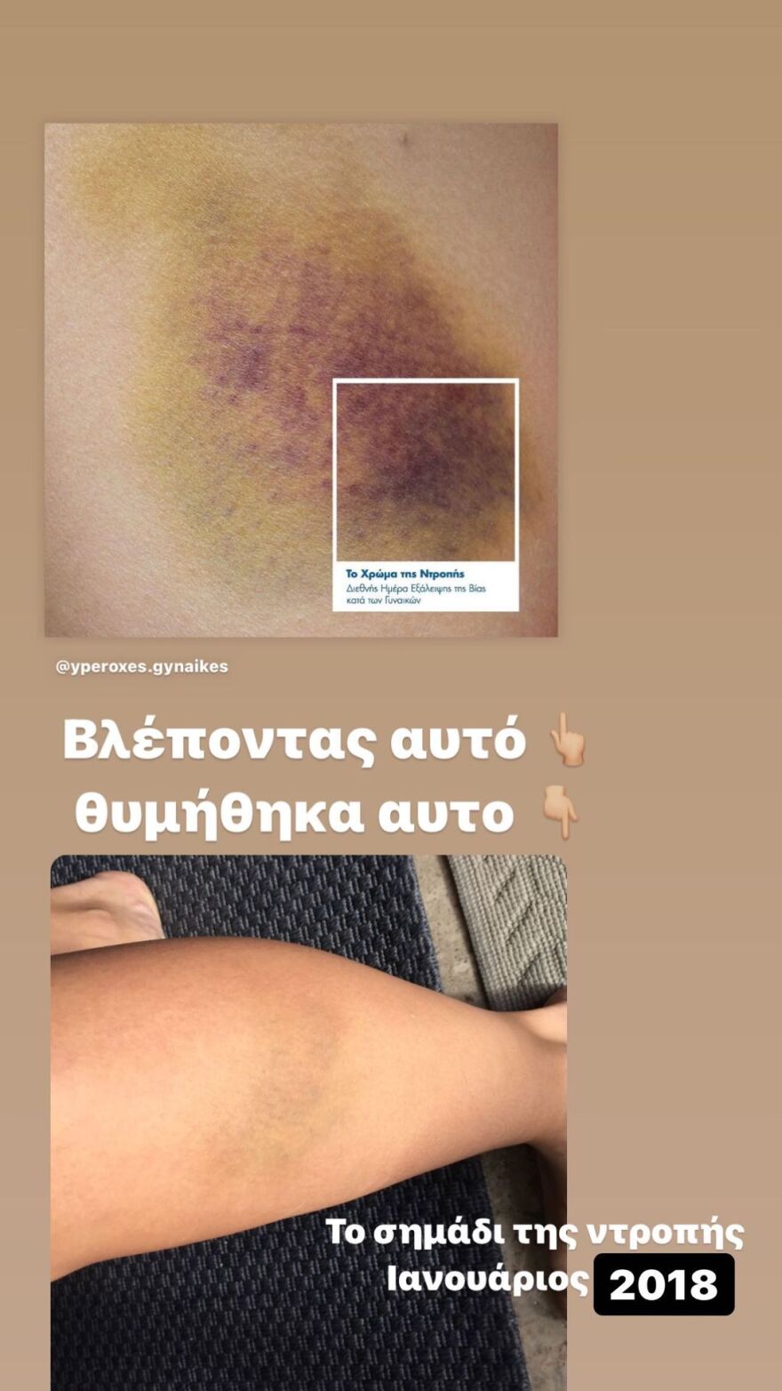 Η Σοφία Παυλίδου εξηγεί τους λόγους που μοιράστηκε τη φωτογραφία με τα σημάδια από την επίθεση που δέχτηκε