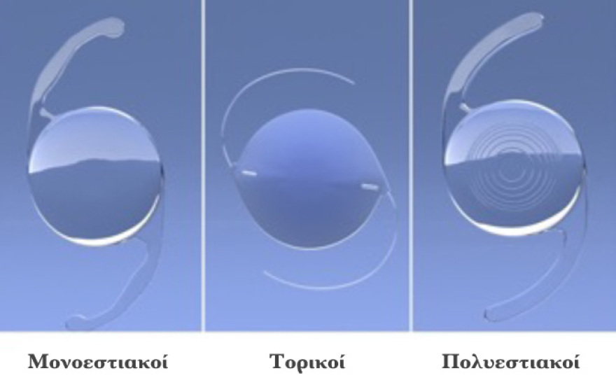 Επέμβαση καταρράκτη: Η συχνότερη επέμβαση στο ανθρώπινο σώμα