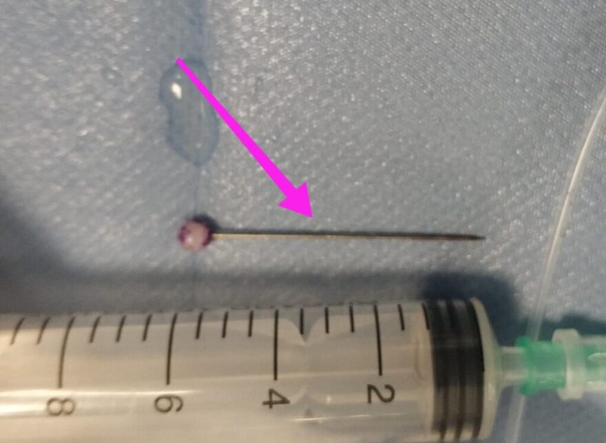 Θεσσαλονίκη: Ανήλικη κατάπιε καρφίτσα - Είχε σταθεί στον αριστερό βρόγχο