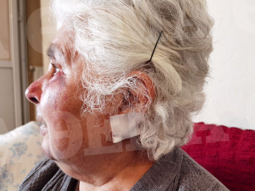 Ληστές ξυλοκόπησαν άγρια 80χρονη στo Αιγάλεω, της έσκισαν τα αυτιά για να της πάρουν τα σκουλαρίκια