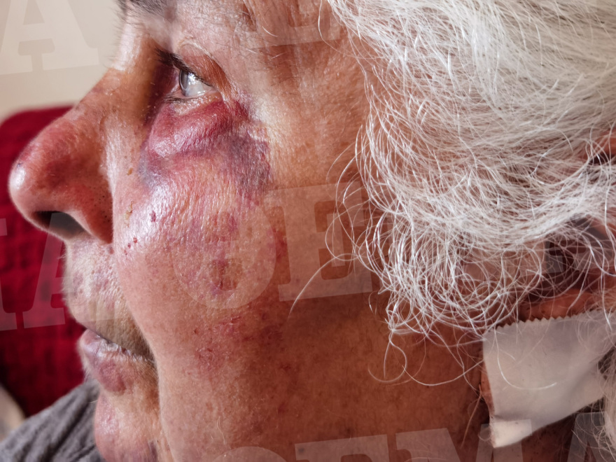 Ληστές ξυλοκόπησαν άγρια 80χρονη στo Αιγάλεω, της έσκισαν τα αυτιά για να της πάρουν τα σκουλαρίκια