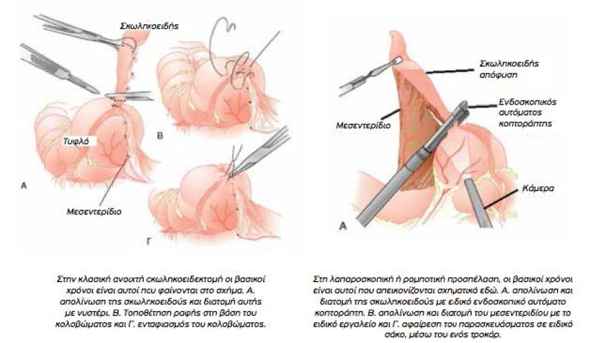 Σκωληκοειδής απόφυση: Τι προκαλεί και πως αντιμετωπίζεται