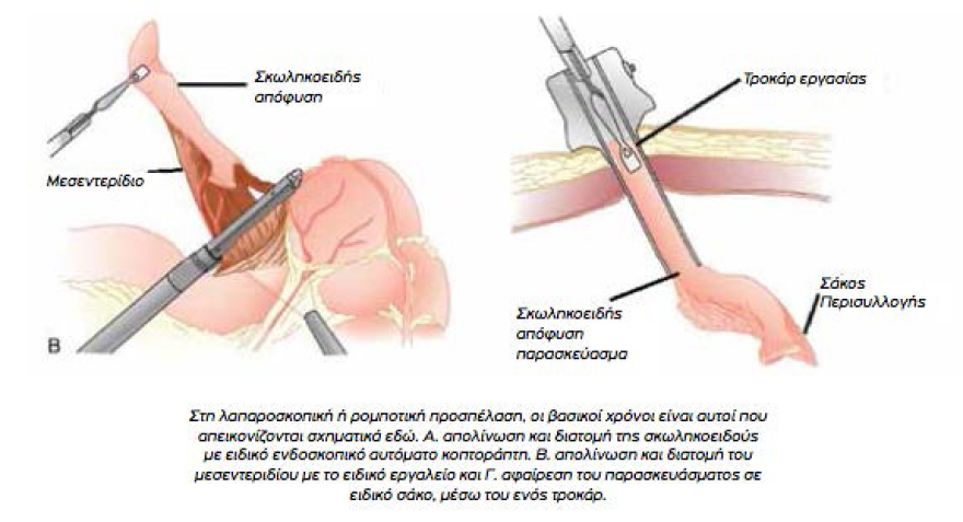 Σκωληκοειδής απόφυση: Τι προκαλεί και πως αντιμετωπίζεται