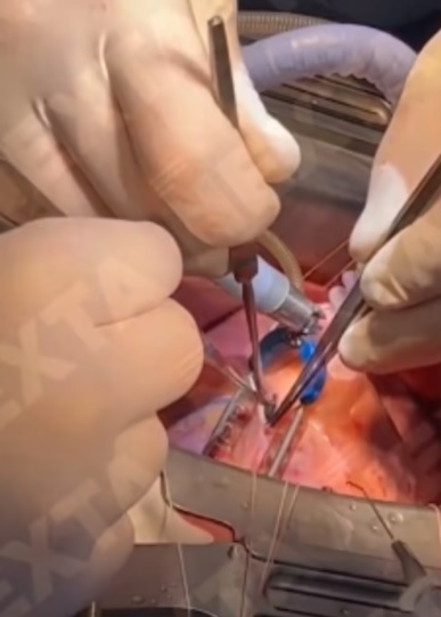 Ουκρανία: Χειρουργοί αφαιρούν σφαίρα από την καρδιά Ουκρανού στρατιώτη