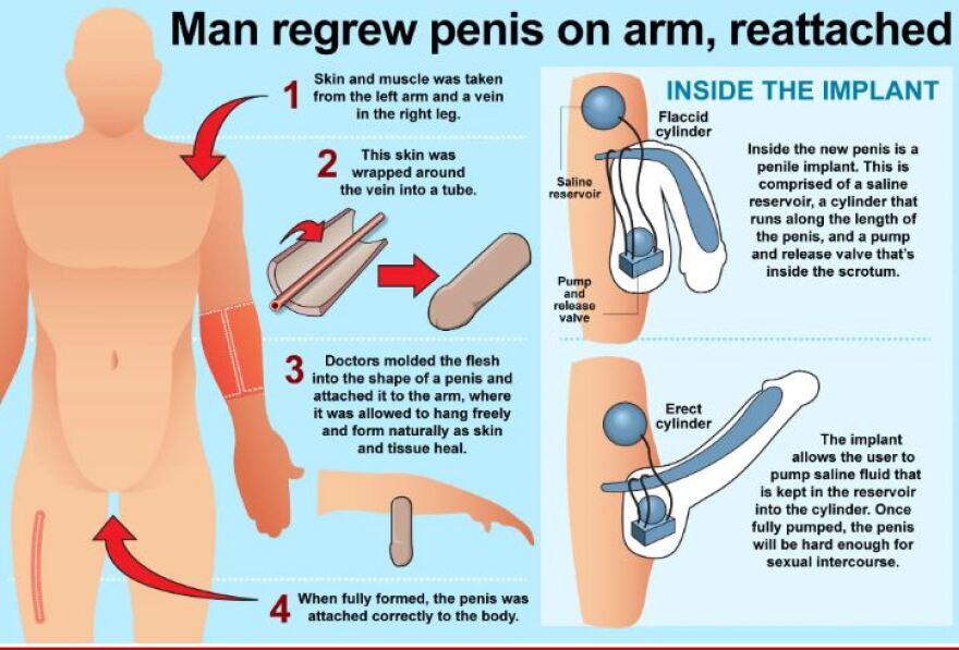 Happy ending για τον Βρετανό με «πέος στο χέρι»: Νιώθει ξανά άνδρας και... φλερτάρει την Κέιτ Μπέκινσεϊλ