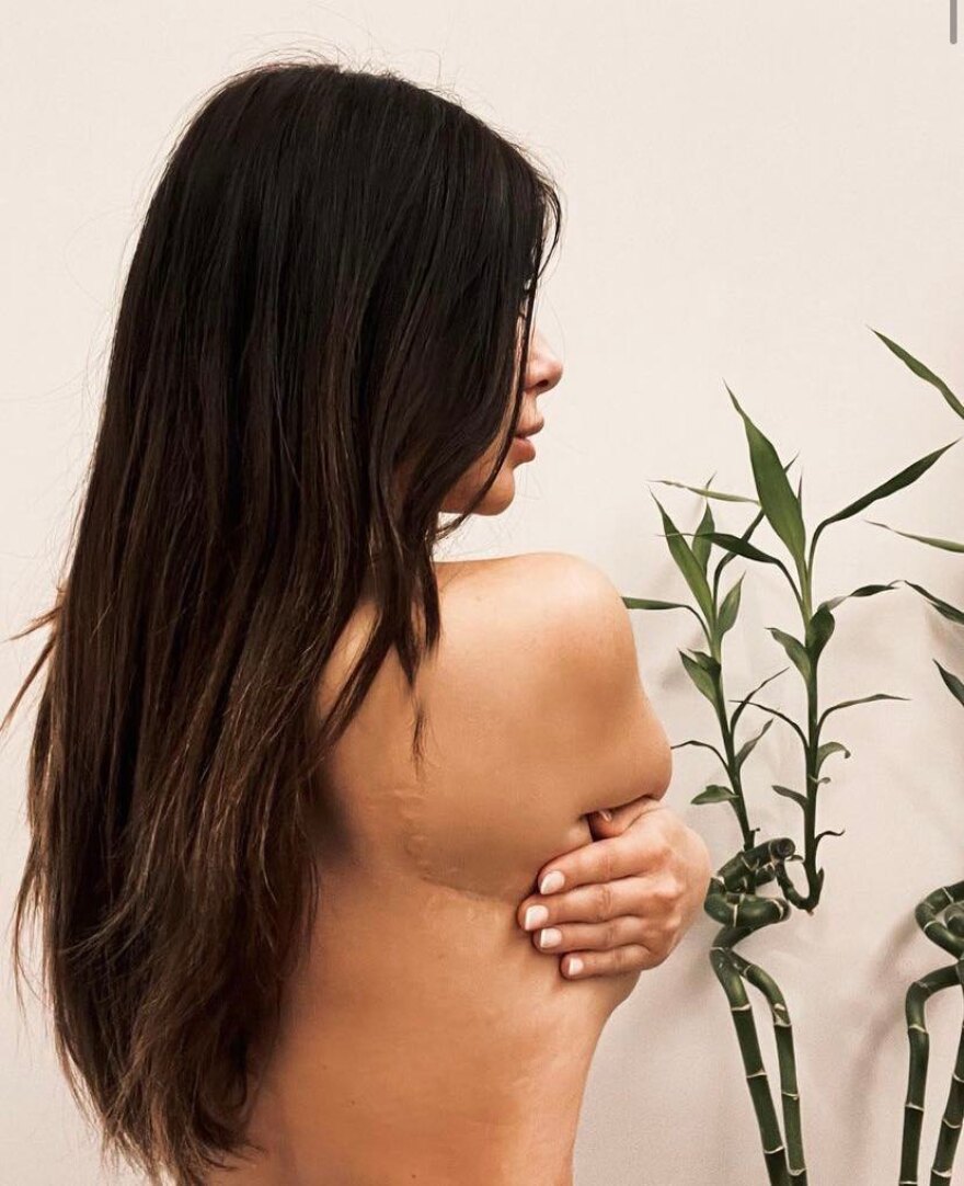 Μίνα Αρναούτη: Δείχνει για πρώτη φορά τα σημάδια από το τροχαίο