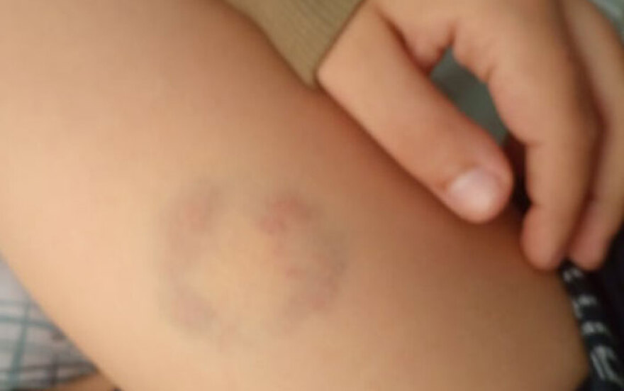 Άρτα: Διευθύντρια σχολείου δάγκωσε 11χρονο μαθητή ΑΜΕΑ