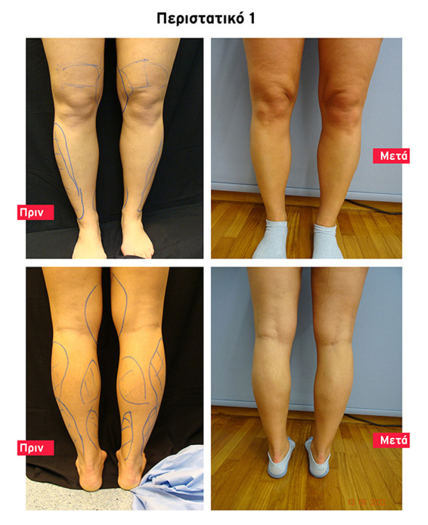 Υπέρμετρη συσσώρευση λίπους: Γιατί συμβαίνει και πώς αντιμετωπίζεται