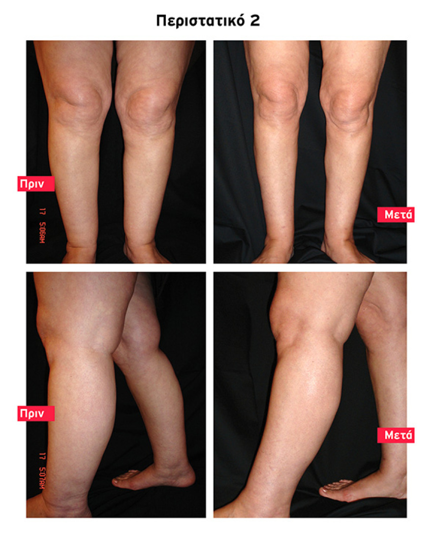 Υπέρμετρη συσσώρευση λίπους: Γιατί συμβαίνει και πώς αντιμετωπίζεται