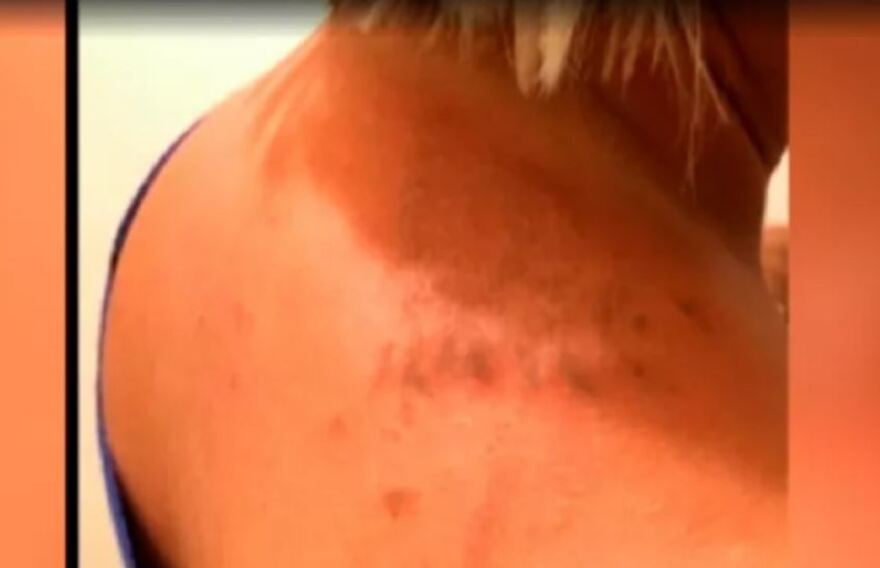 Μωβ μέδουσες: «Με έτσουζε λες και μου έριξαν βιτριόλι, έβραζε το δέρμα μου», λέει γυναίκα που την τσίμπησε