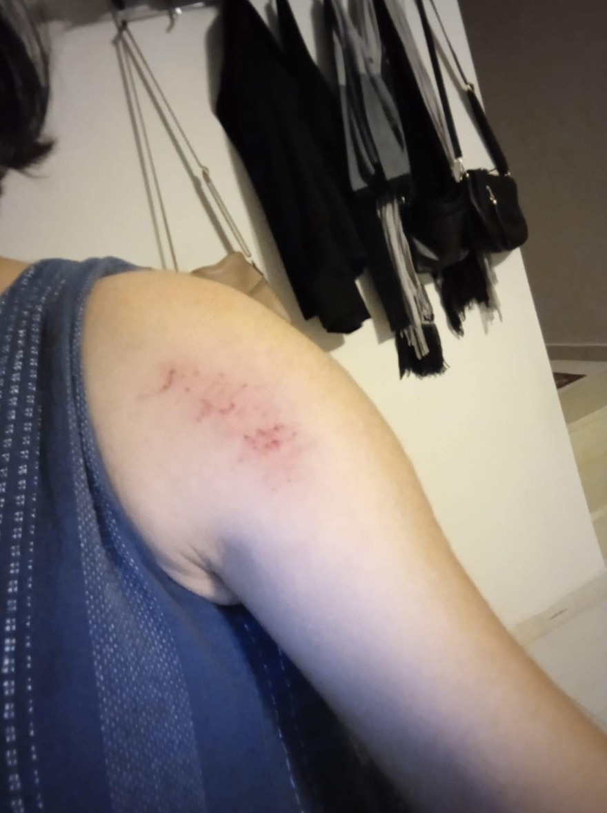 Χαλάζι σε μέγεθος αυγού στην Καστοριά - Τραυματίστηκε γυναίκα στον ώμο