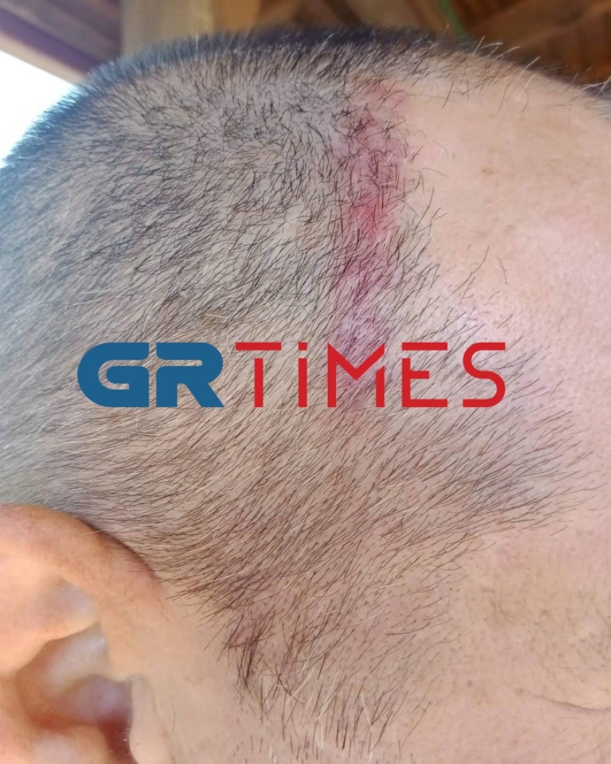 Θεσσαλονίκη: Άστεγος τραυμάτισε αστυνομικό και στην κατοχή του βρέθηκε «οπλοστάσιο» - Δείτε φωτογραφίες