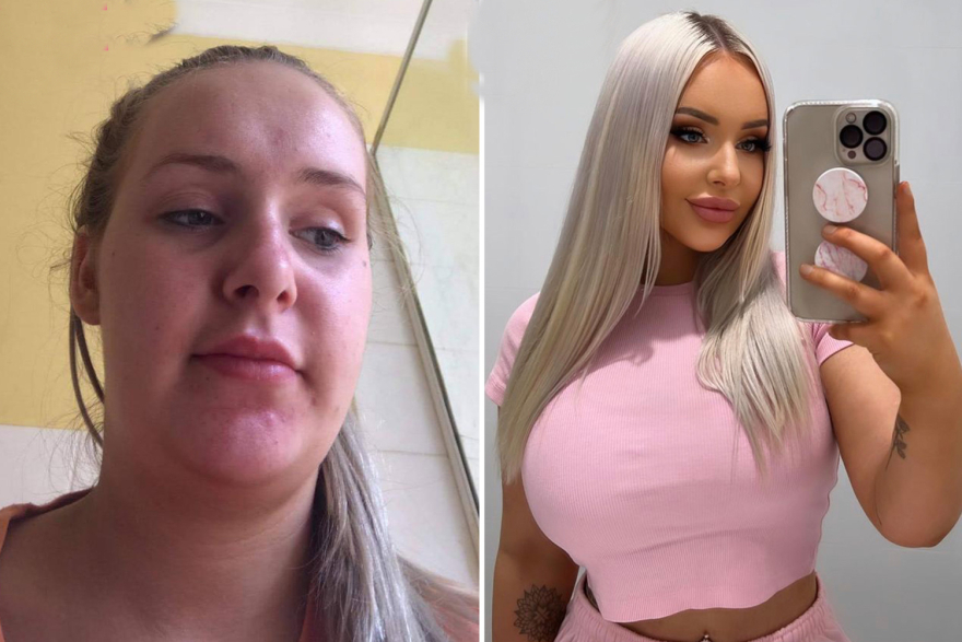 «Ζωντανή Μπάρμπι»: Η 24χρονη που ξόδεψε πάνω από 70.000 ευρώ σε πλαστικές  