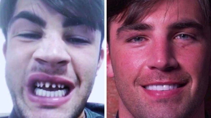 Βρετανία: Σάλος με τα «δόντια Τουρκίας» - Πολίτες επιστρέφουν στη χώρα με πόνους και επιπλοκές