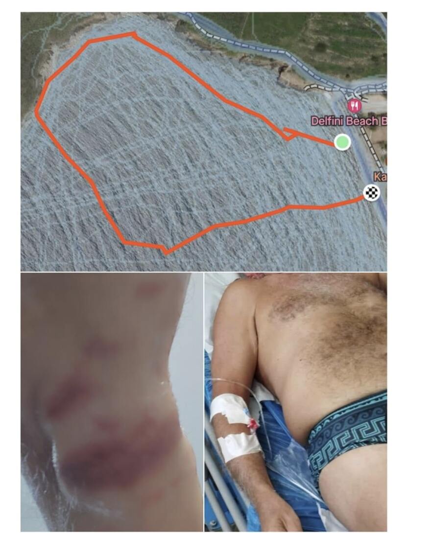 Κολυμβητής περιγράφει την εμπειρία του με μωβ μέδουσα - Πήγε στο νοσοκομείο