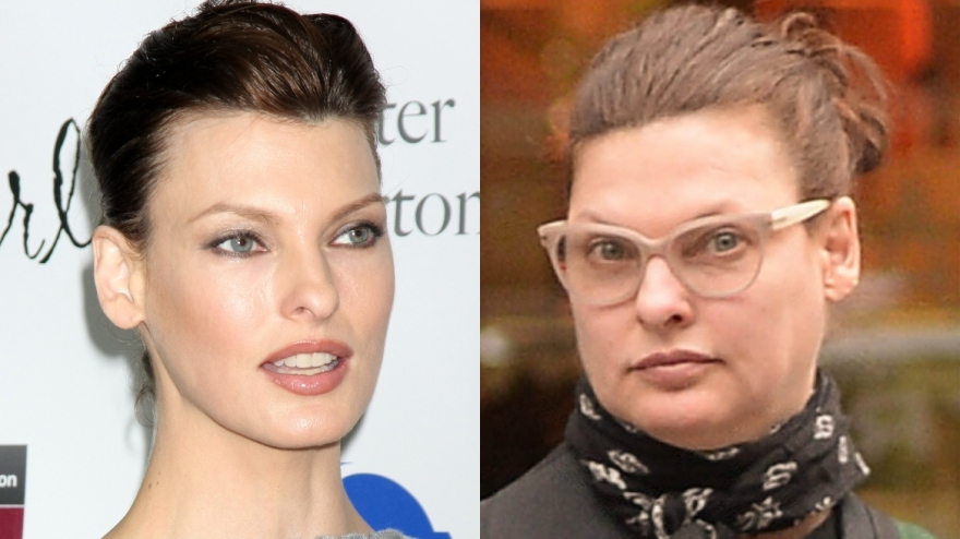 Πέντε διάσημες που μετάνιωσαν για τις πλαστικές που έκαναν