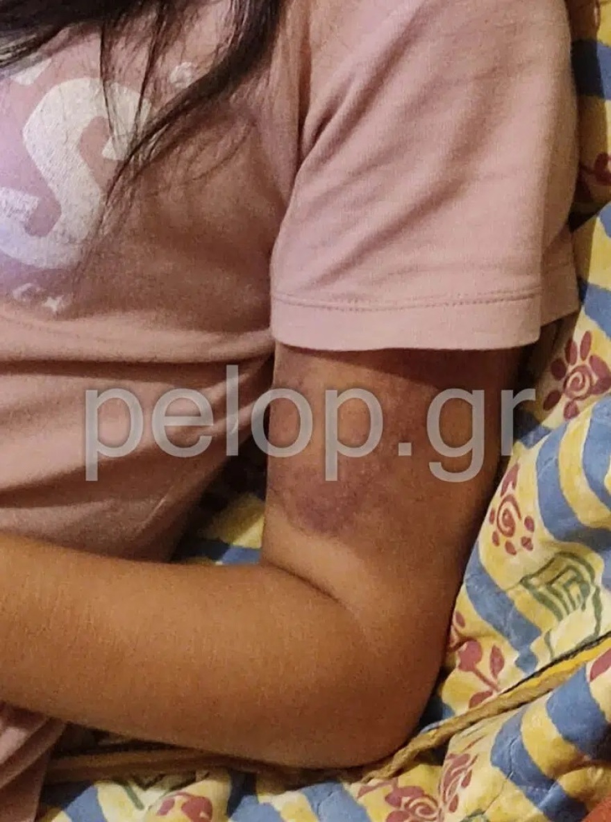 Πάτρα: Ρομά απήγαγε την 16χρονη κόρη τους και την ξυλοκόπησε