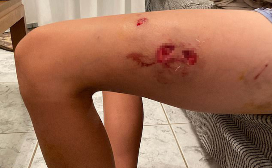 Εκατό ράμματα στον 50χρονο που δέχθηκε επίθεση από αγέλη σκύλων - «Πάλεψα για να σώσω τα παιδιά μου»