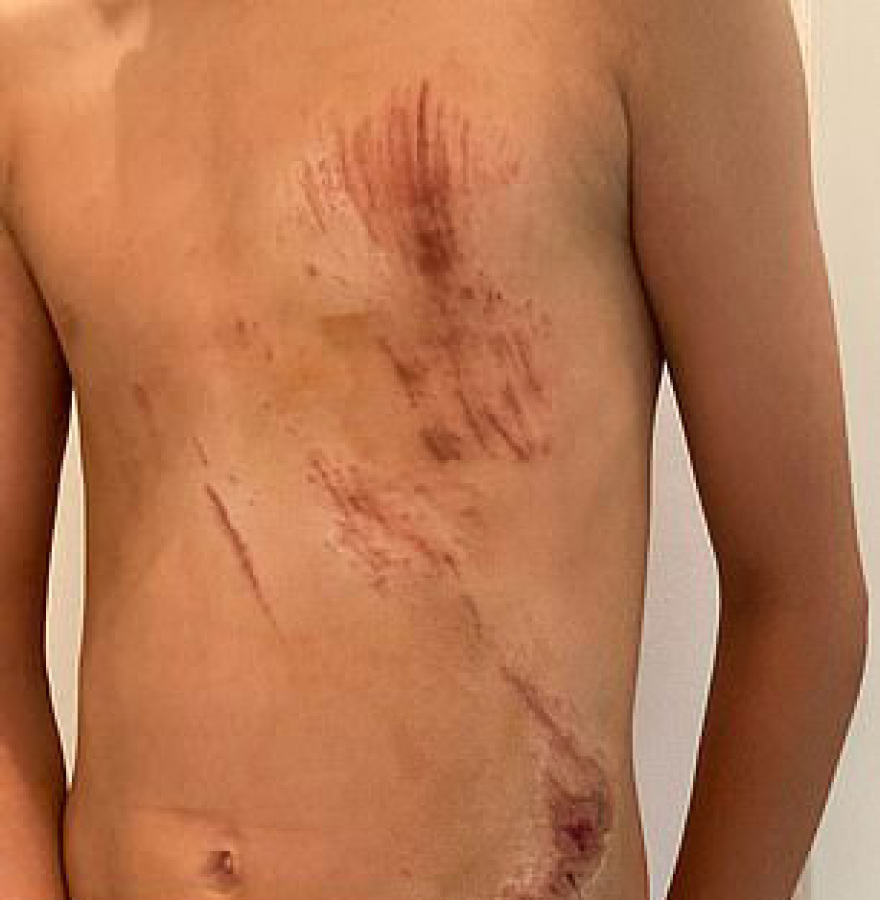 Εκατό ράμματα στον 50χρονο που δέχθηκε επίθεση από αγέλη σκύλων - «Πάλεψα για να σώσω τα παιδιά μου»