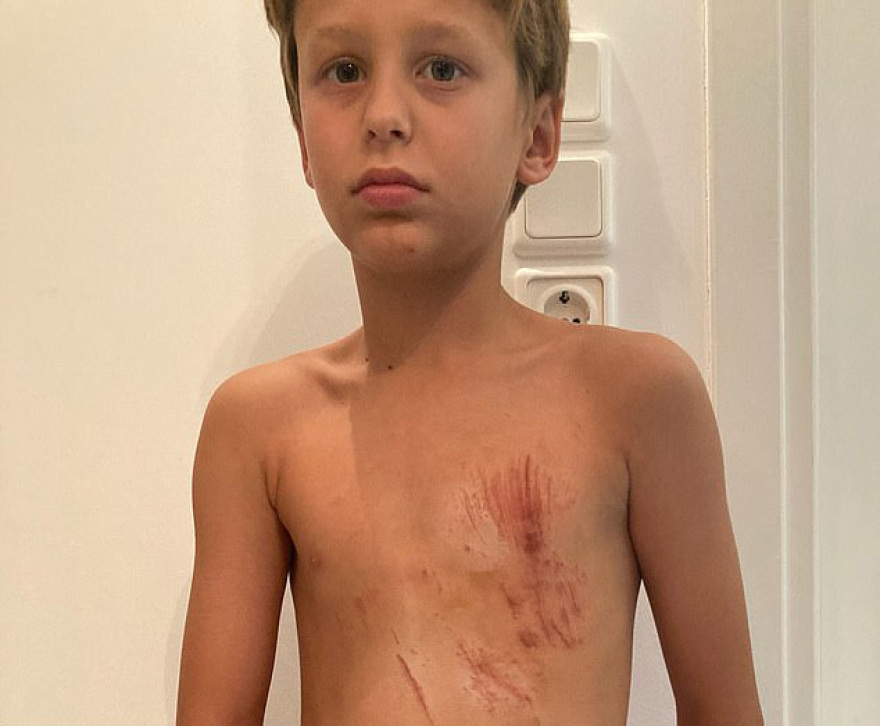 Εκατό ράμματα στον 50χρονο που δέχθηκε επίθεση από αγέλη σκύλων - «Πάλεψα για να σώσω τα παιδιά μου»