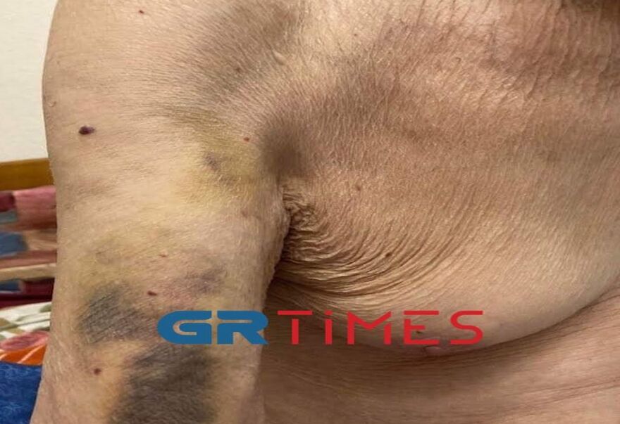 Θεσσαλονίκη: «Δεν ξαναπάω σε νοσοκομείο, έζησα ένα  εφιάλτη» λέει ο 98χρονος για τον ξυλοδαρμό στο «Παπαγεωργίου»