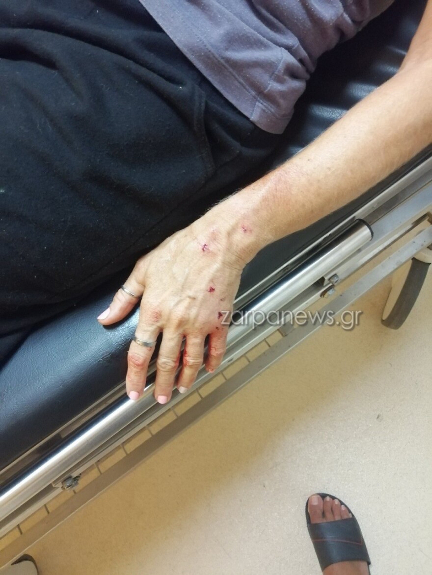 Χανιά: Σκληρές εικόνες από άγρια επίθεση σκύλου σε 57χρονη - «Τρέμω να βγω από το σπίτι» λέει