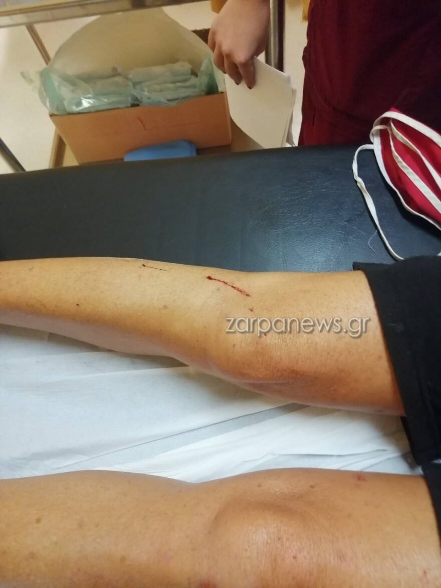 Χανιά: Σκληρές εικόνες από άγρια επίθεση σκύλου σε 57χρονη - «Τρέμω να βγω από το σπίτι» λέει