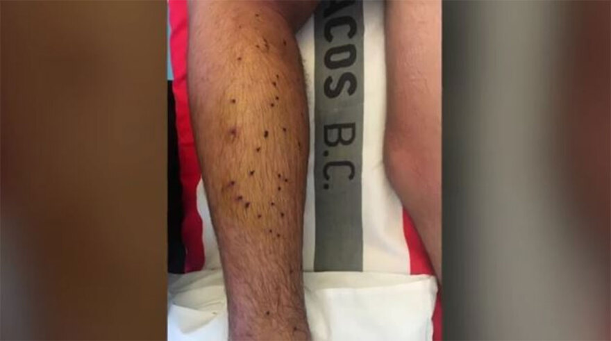 Αλεποχώρι: Φωτογραφίες ντοκουμέντο από τα τραύματα του 14χρονου 