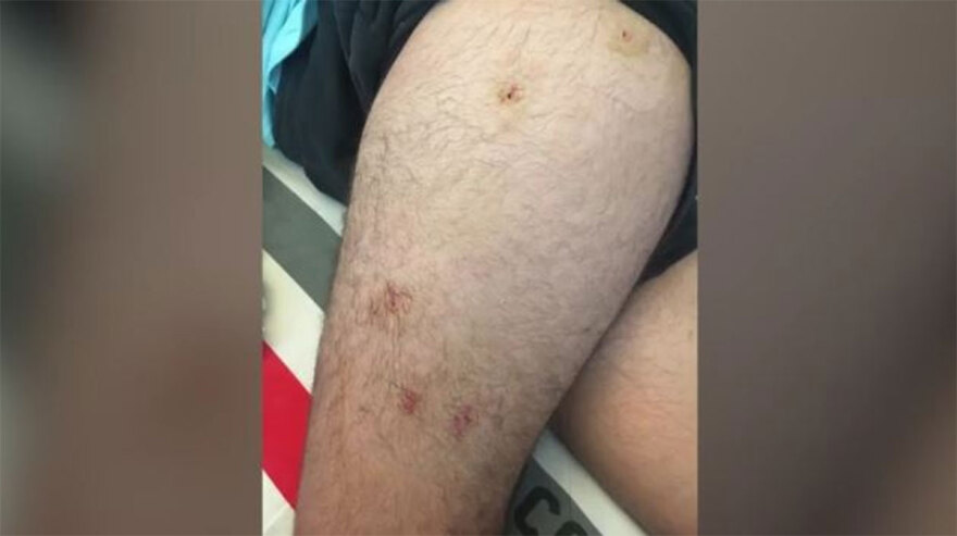 Αλεποχώρι: Φωτογραφίες ντοκουμέντο από τα τραύματα του 14χρονου 