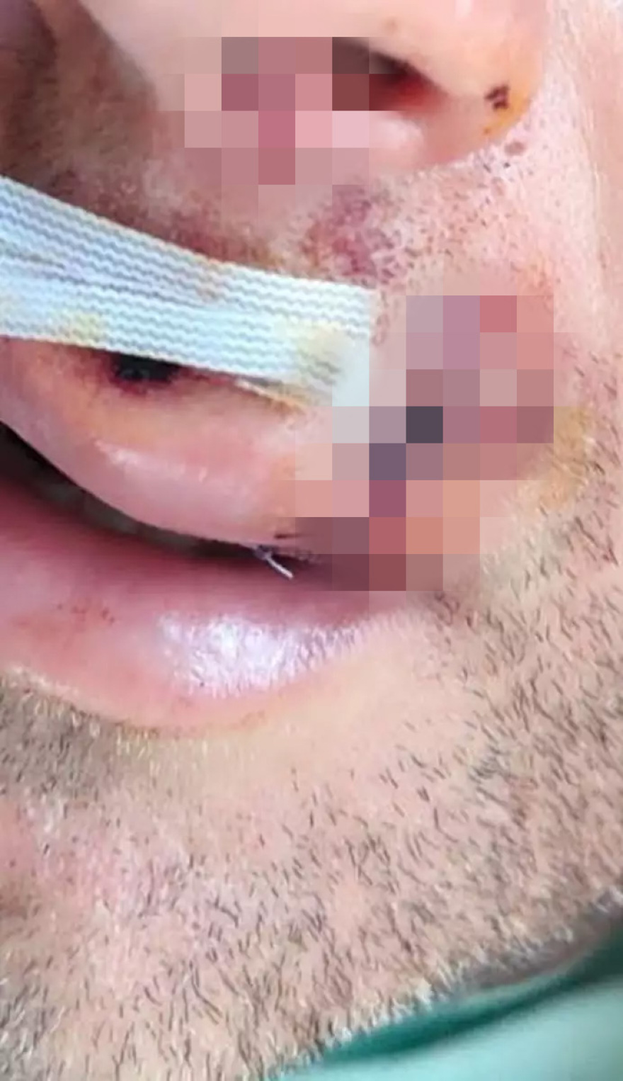 Φωτογραφίες από τους τραυματισμένους αστυνομικούς μετά την επίθεση από τουλάχιστον 20 άτομα στη Λάρισα