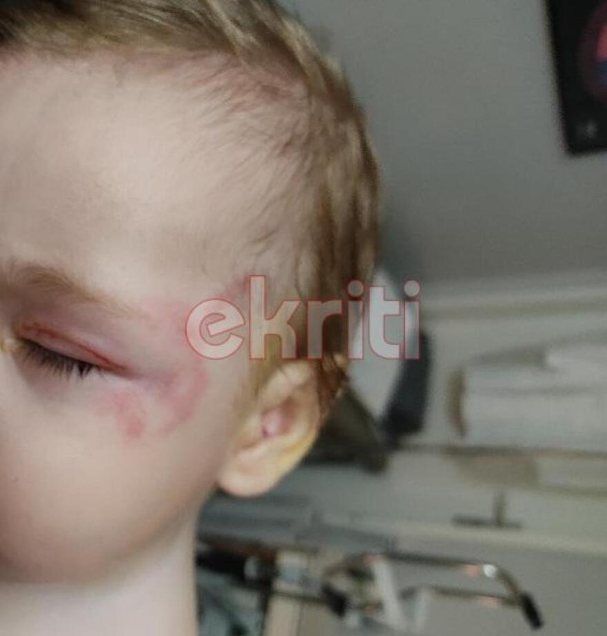 Κρήτη: Στο ΠΑΓΝΗ το βρέφος που γλίτωσε από τα δόντια του λυκόσκυλου - Δείτε φωτογραφίες