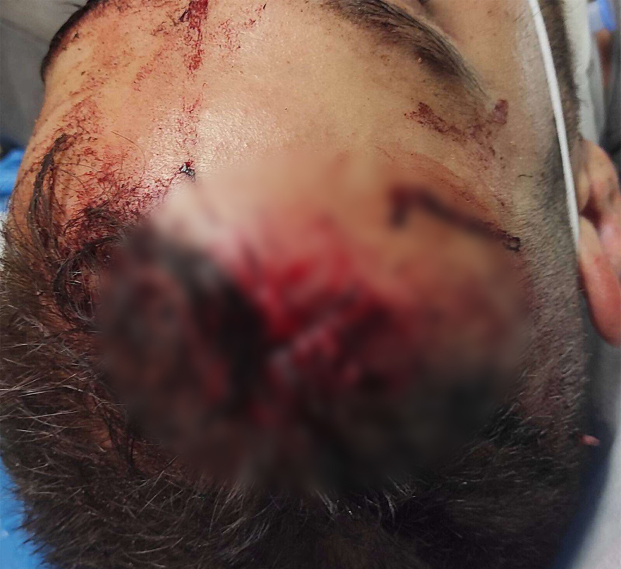 Allou Fun Park: Φωτογραφίες του 25χρονου τραυματία λίγες ώρες μετά το ατύχημα