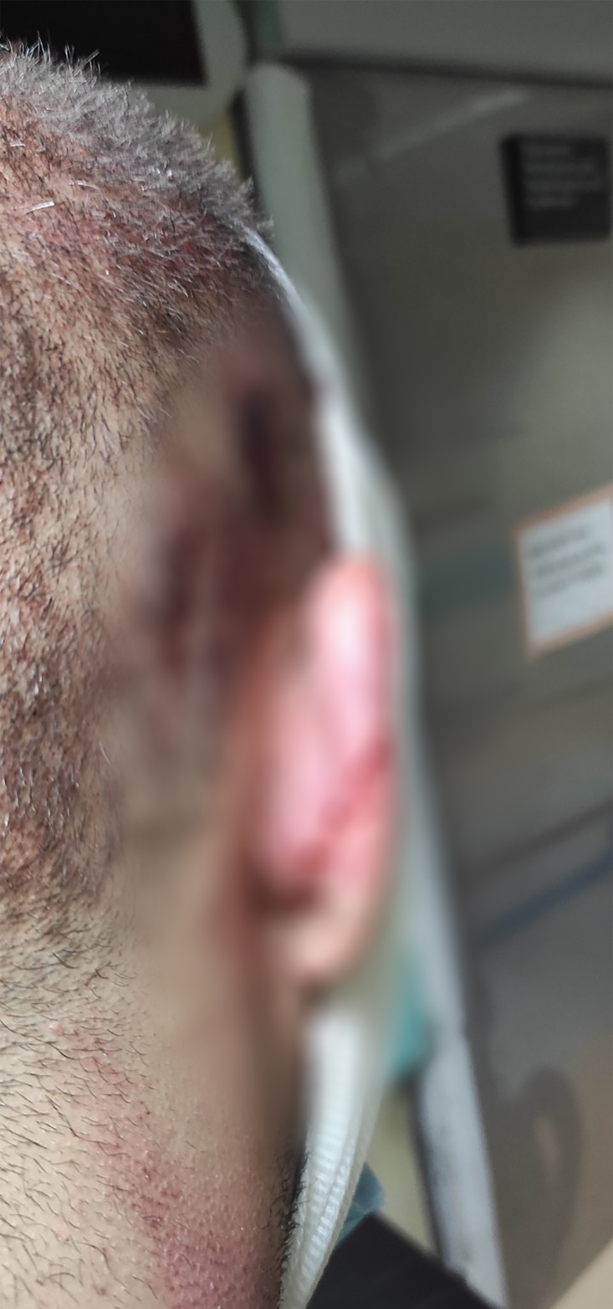 Allou Fun Park: Φωτογραφίες του 25χρονου τραυματία λίγες ώρες μετά το ατύχημα