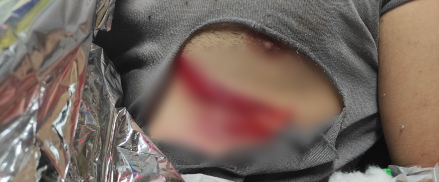 Allou Fun Park: Φωτογραφίες του 25χρονου τραυματία λίγες ώρες μετά το ατύχημα