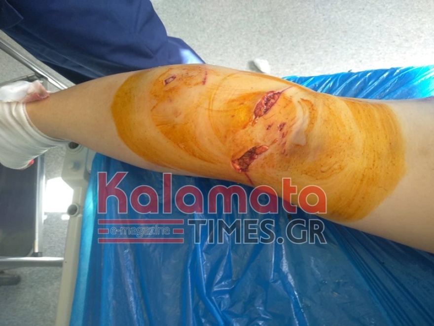 Καλαμάτα: Σκληρές εικόνες από επίθεση σκύλων σε 34χρονη - «Νόμιζα ότι θα με σκοτώσουν»