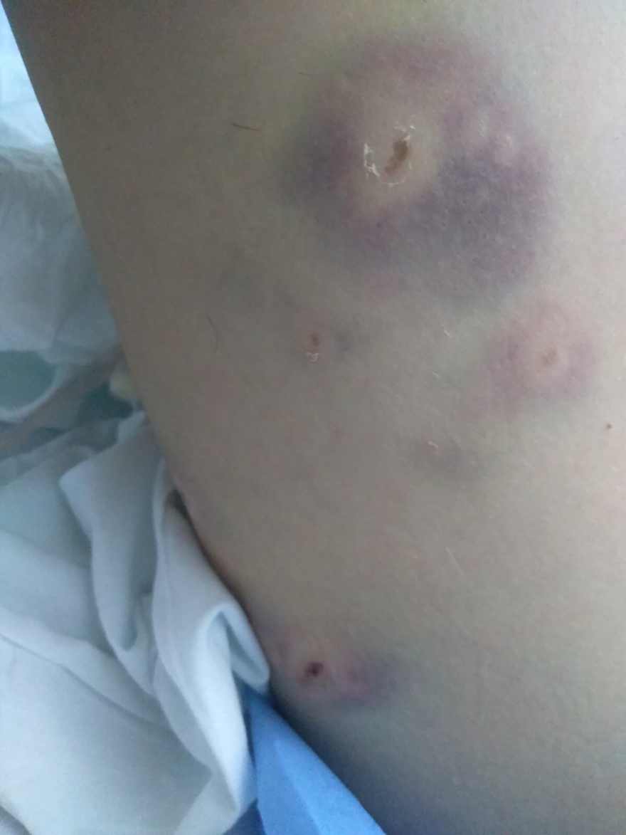 Καλαμάτα: «Φοβήθηκα για τη ζωή μου, με κατασπάραξαν» λέει η 34χρονη που δέχθηκε επίθεση σκύλων στην Καλαμάτα