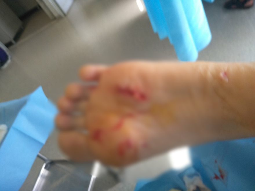 Καλαμάτα: «Φοβήθηκα για τη ζωή μου, με κατασπάραξαν» λέει η 34χρονη που δέχθηκε επίθεση σκύλων στην Καλαμάτα