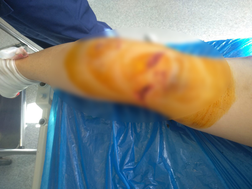 Καλαμάτα: «Φοβήθηκα για τη ζωή μου, με κατασπάραξαν» λέει η 34χρονη που δέχθηκε επίθεση σκύλων στην Καλαμάτα